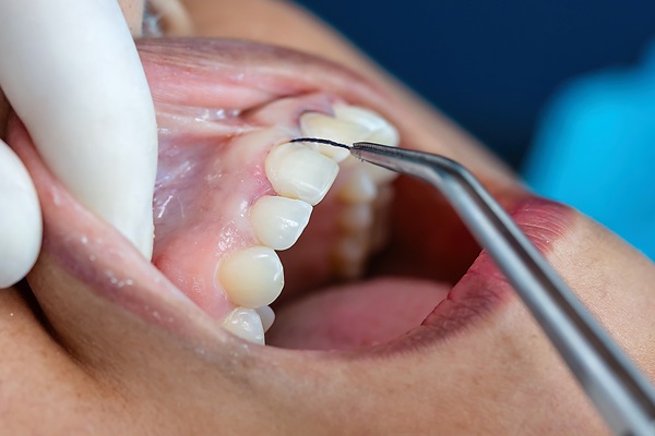 Can Gum Disease Be Treated At Home?
