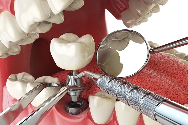 Surgical Implant Placement For Tooth Replacement